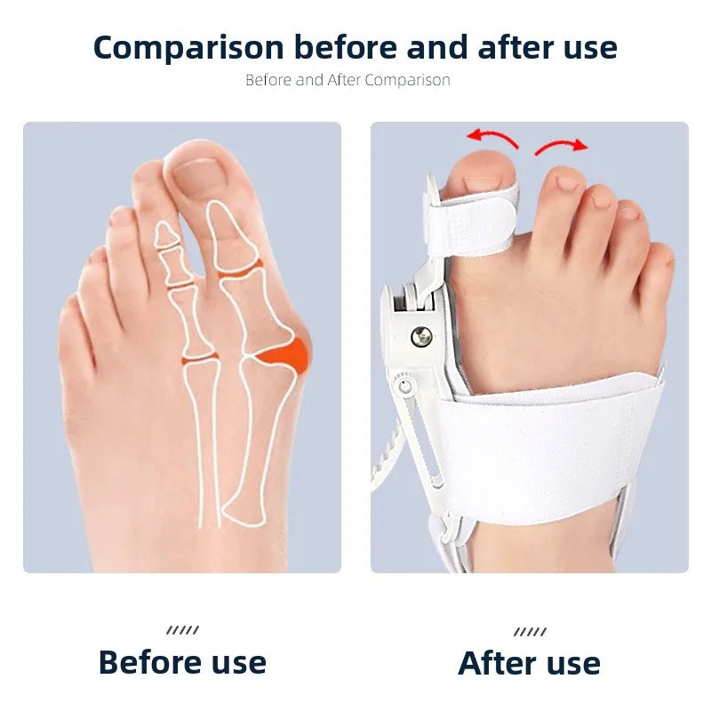 Adjustable Bunion Relief Orthosis Naalani